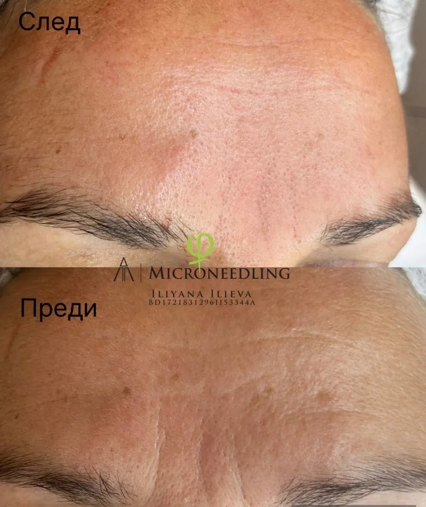 Микронидлинг – чело, бръчки, преди и след