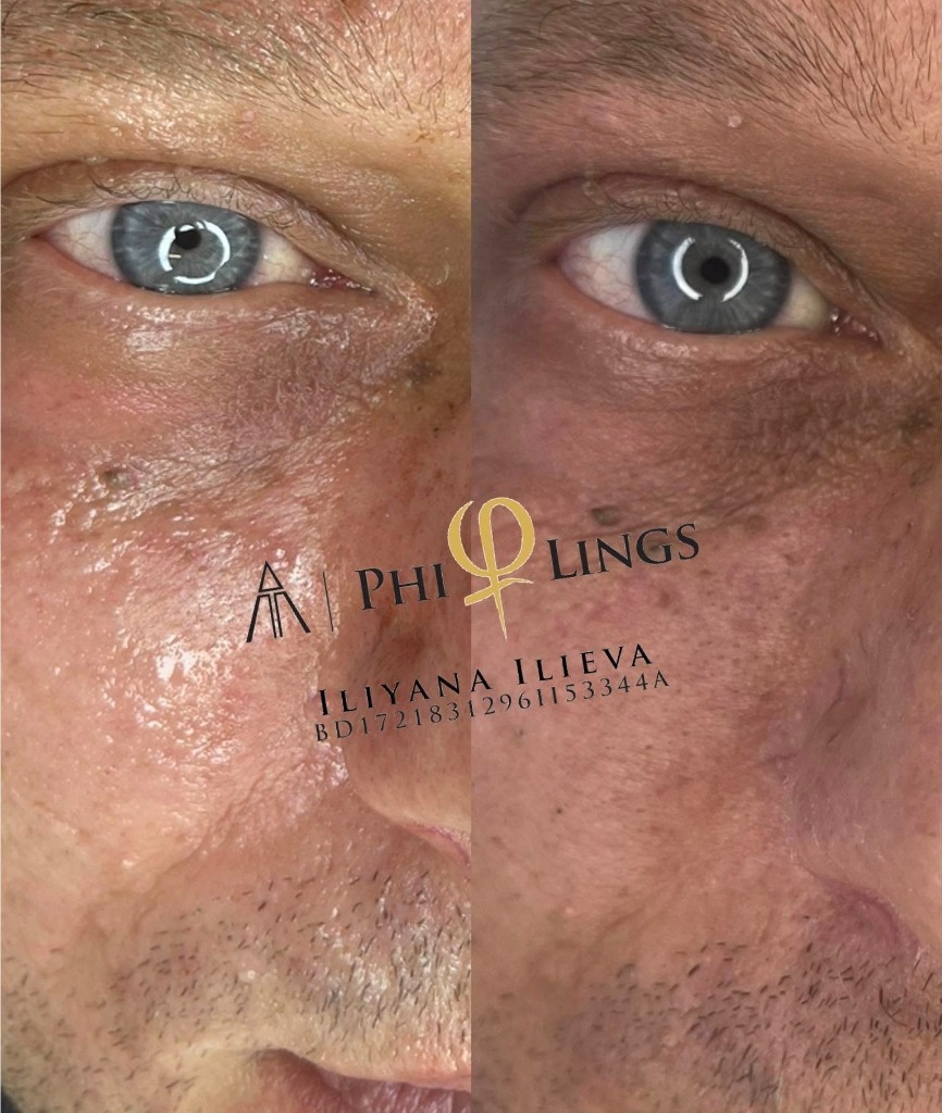 Микронидлинг – чело преди и след