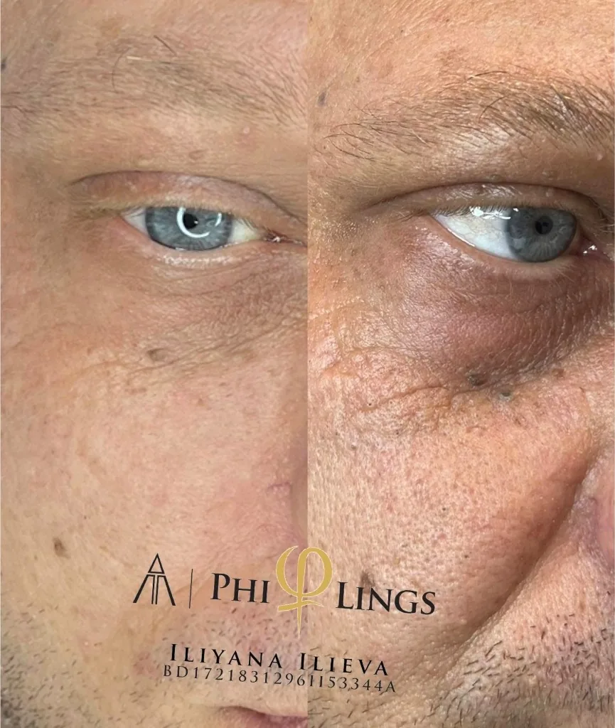 Микронидлинг – буза и нос преди и след