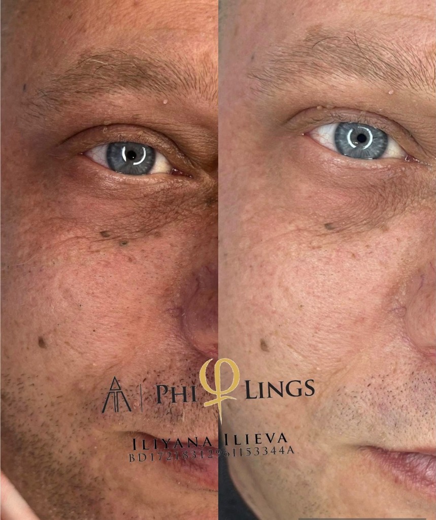 Микронидлинг – чело преди и след