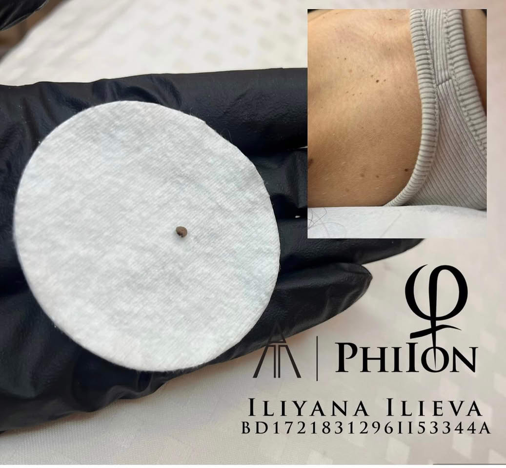 Премахнат фибром от зоната на шията - PhiIon процедура