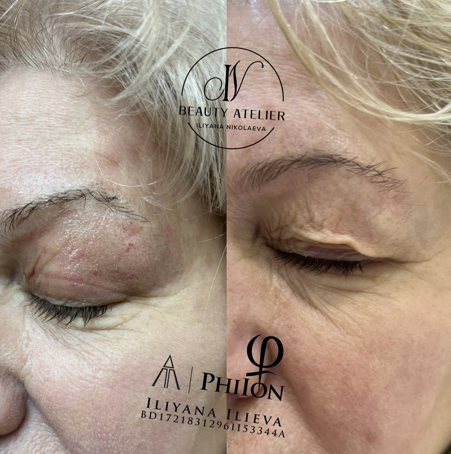 Плазма Пен – Beauty Atelier IN