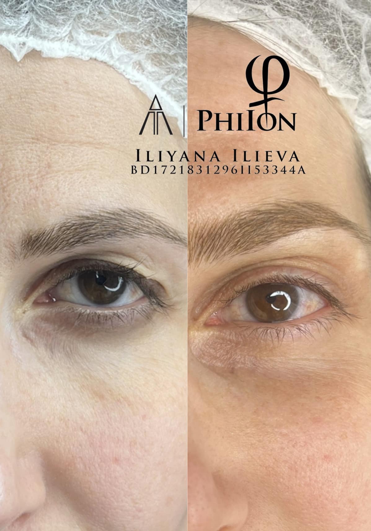 Плазма Пен – Beauty Atelier IN