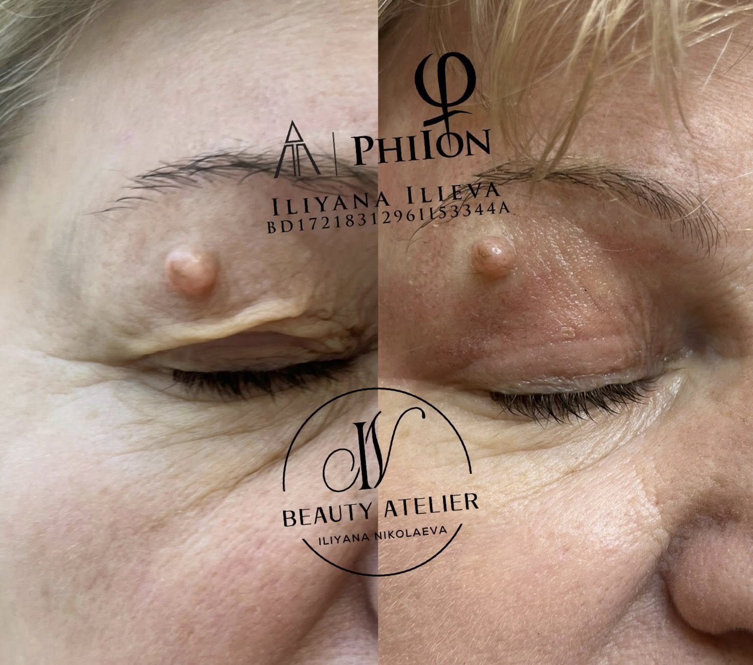 Плазма Пен – Beauty Atelier IN