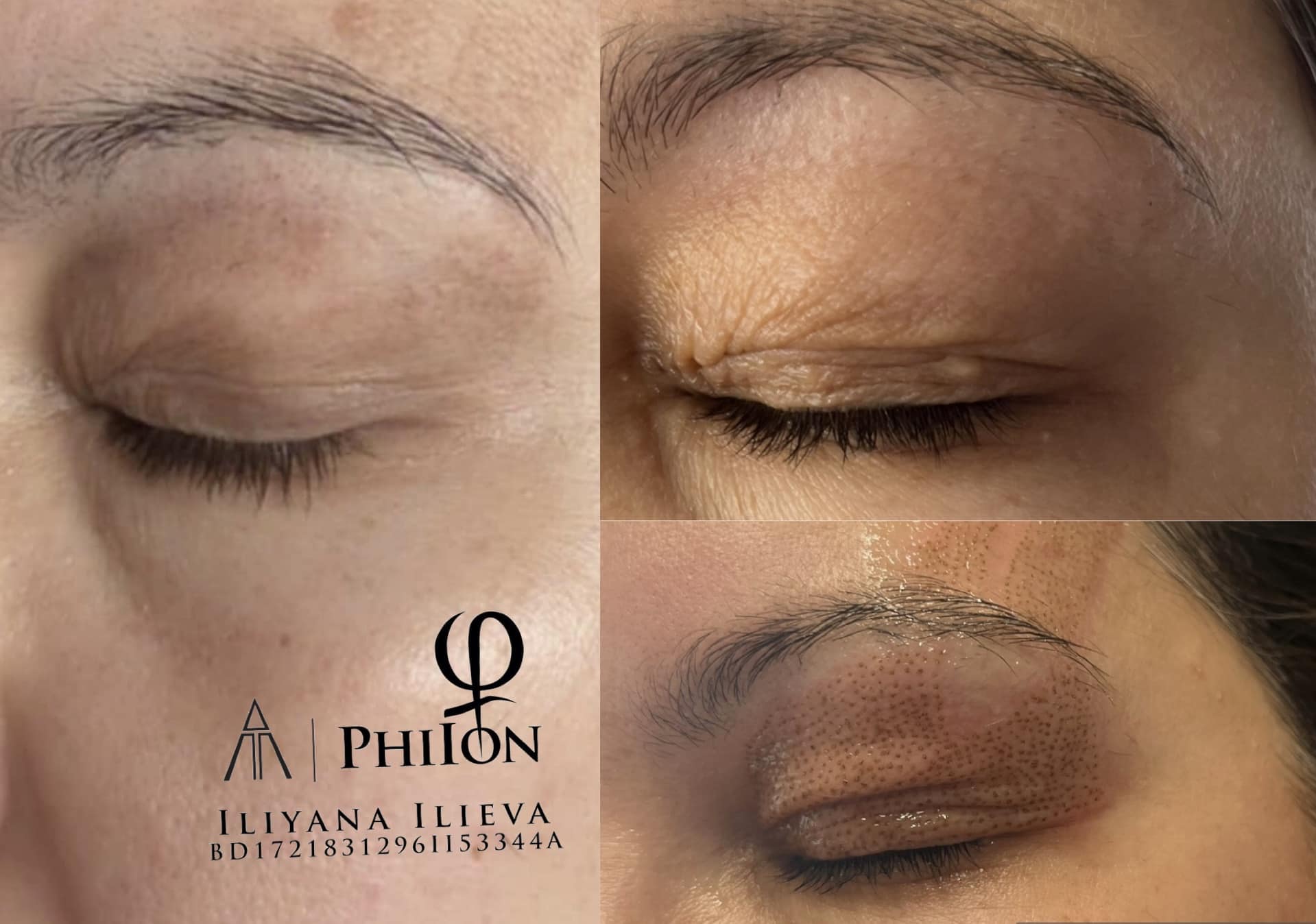 Плазма Пен – Beauty Atelier IN