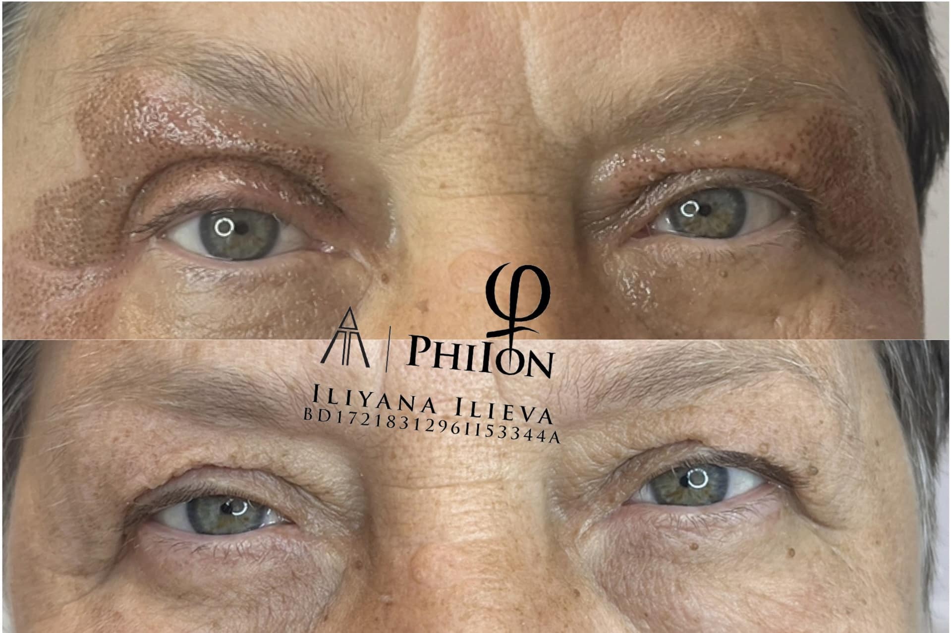 Плазма Пен – Beauty Atelier IN