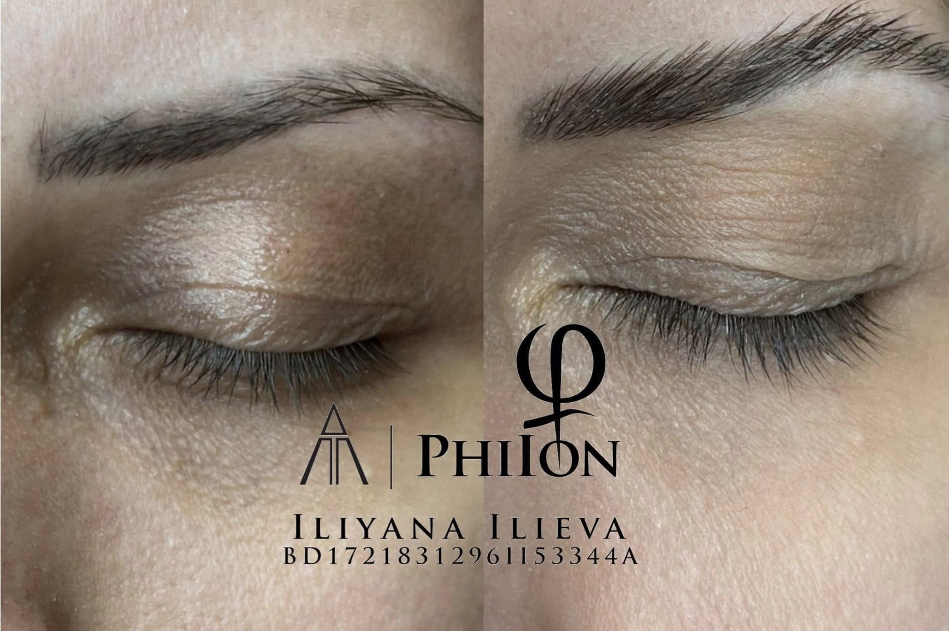 Плазма Пен – Beauty Atelier IN