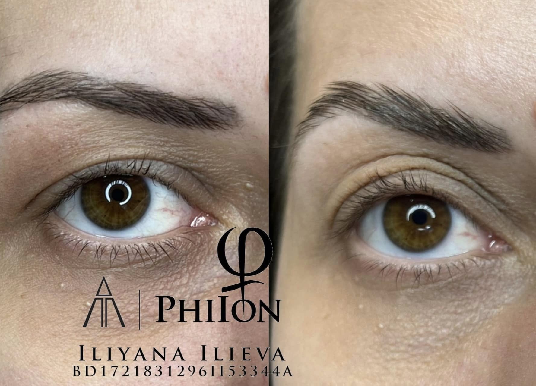 Плазма Пен – Beauty Atelier IN