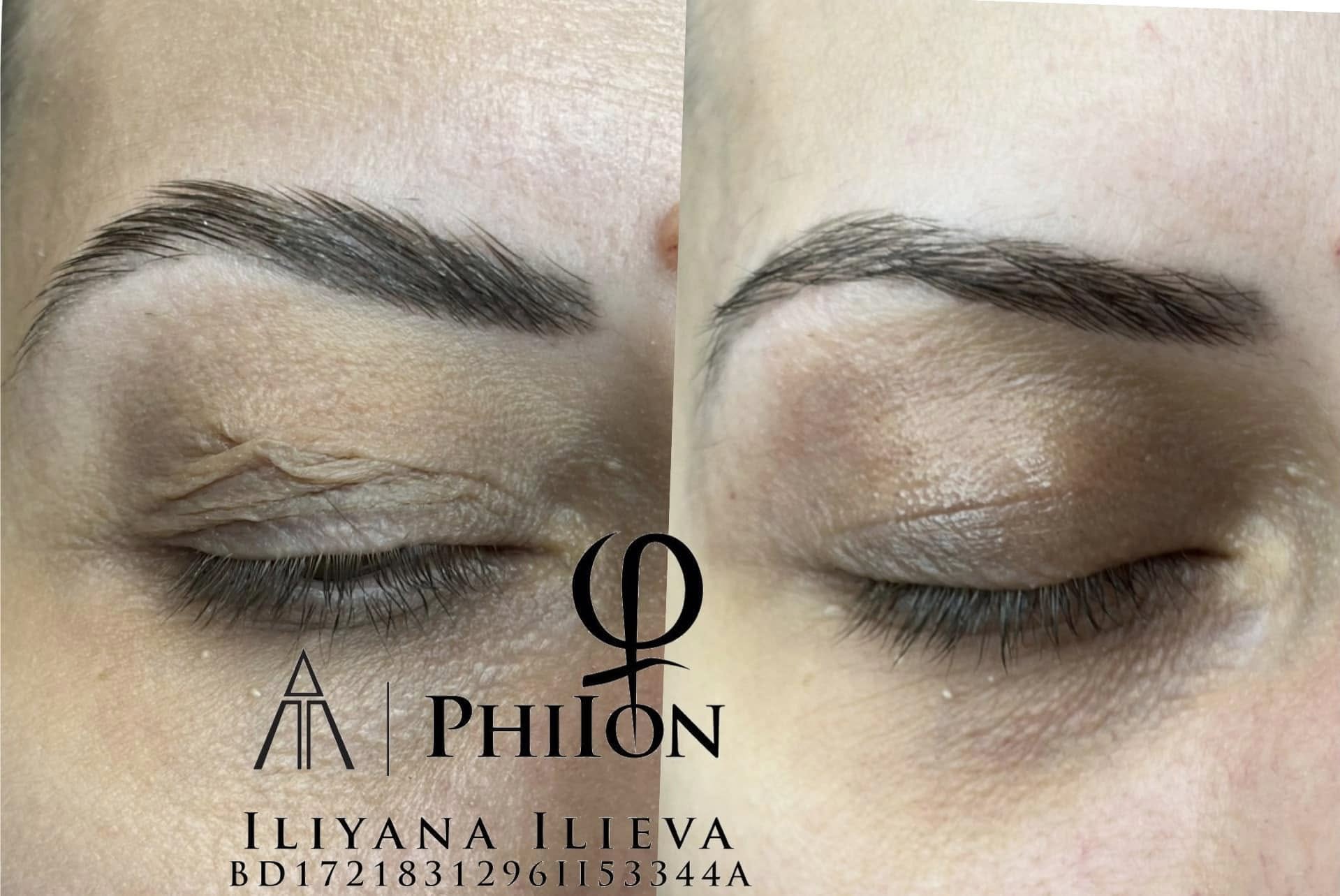 Плазма Пен – Beauty Atelier IN