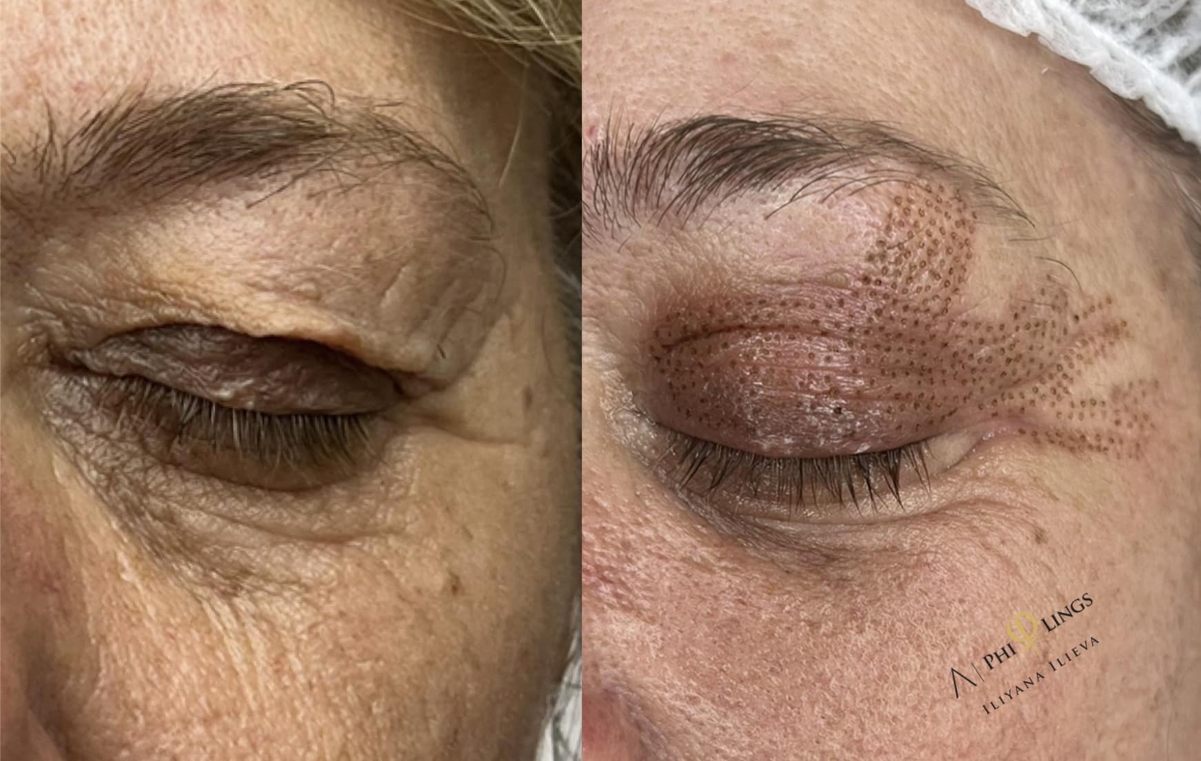 Плазма Пен – Beauty Atelier IN