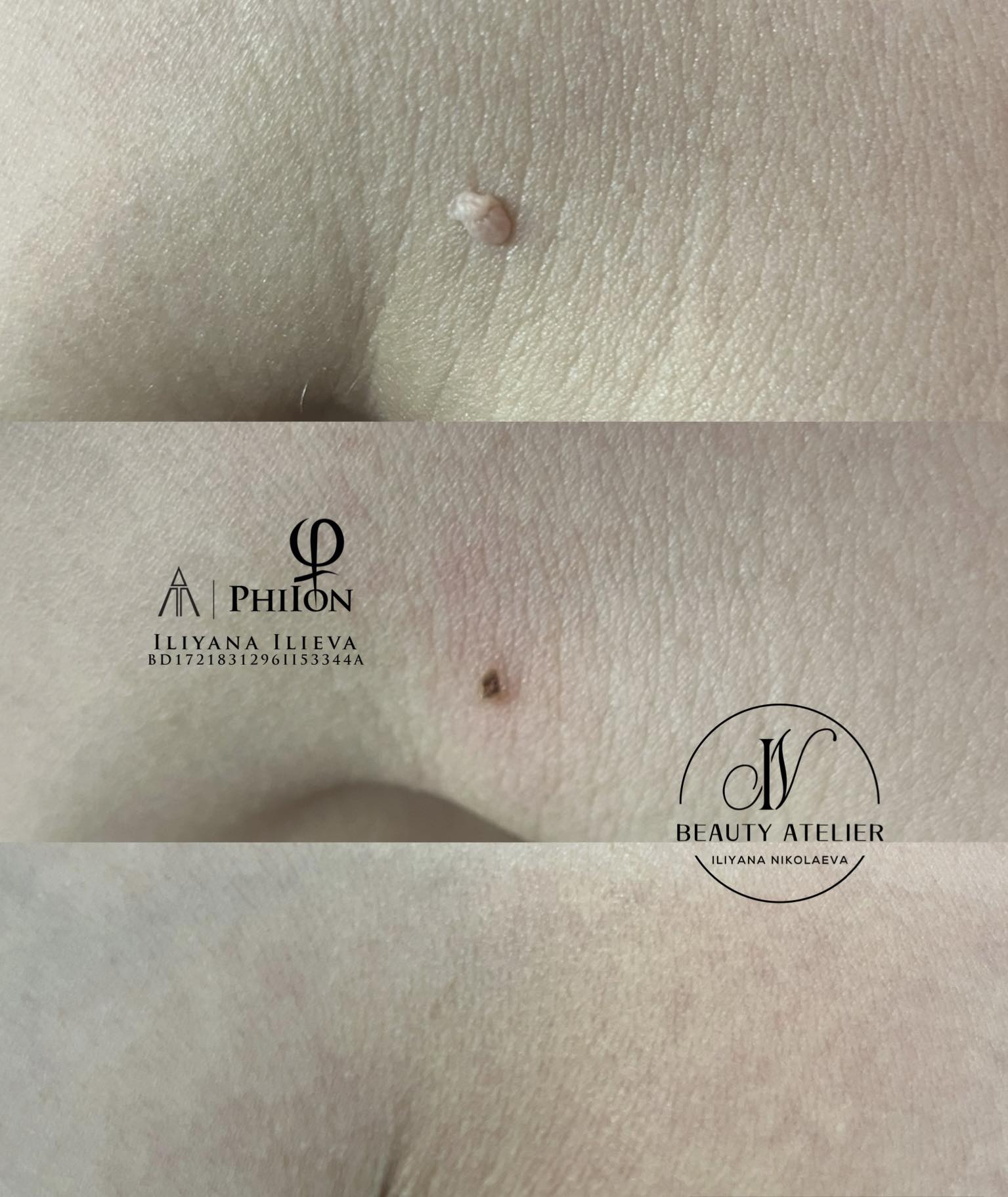 Плазма Пен – Beauty Atelier IN