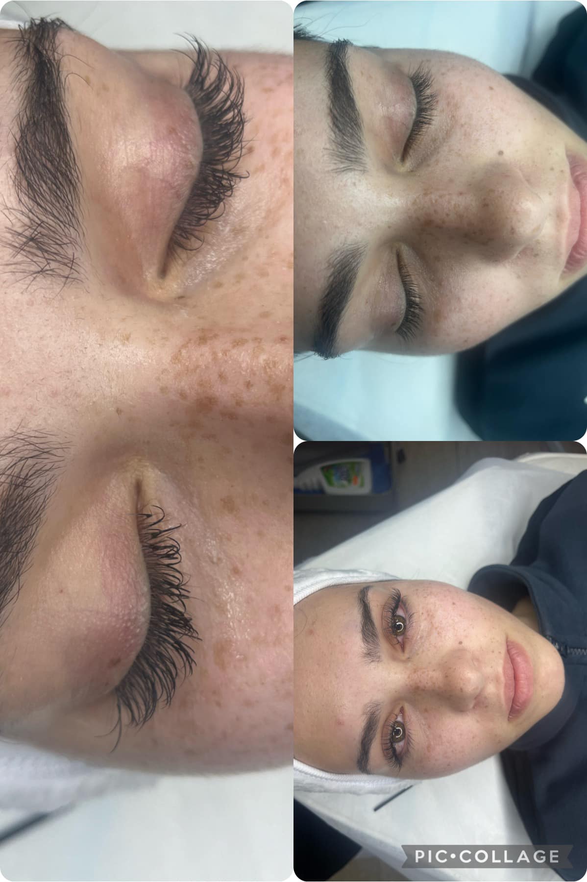 Миглопластика – Beauty Atelier IN