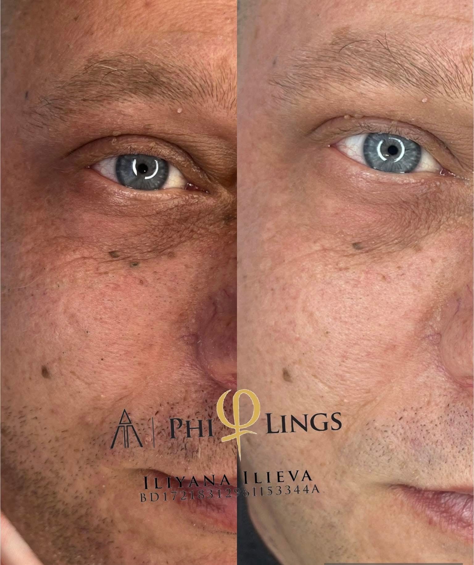 Микронидлинг – Beauty Atelier IN