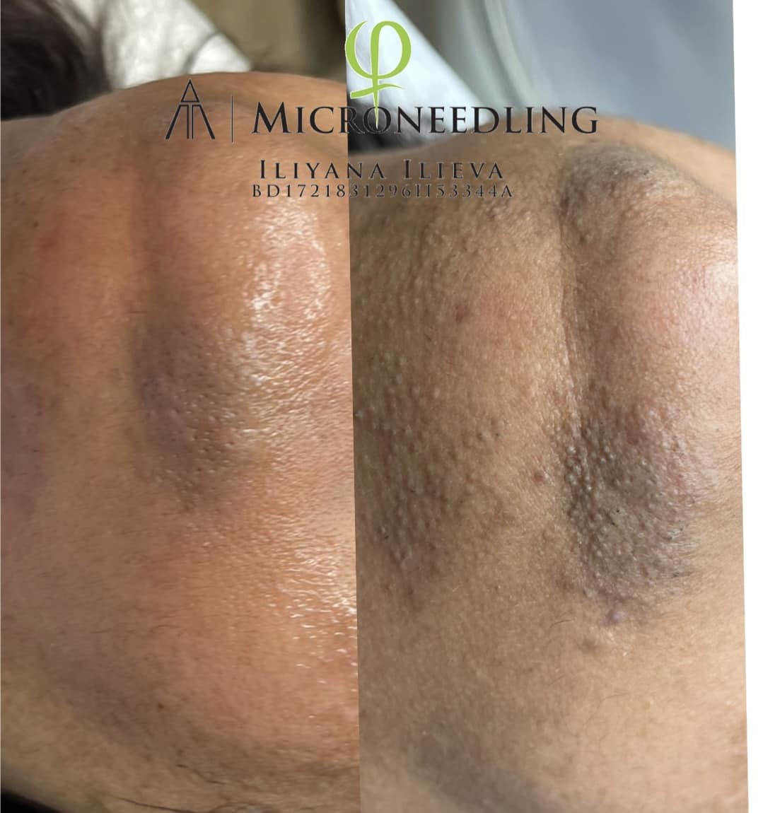 Микронидлинг – Beauty Atelier IN