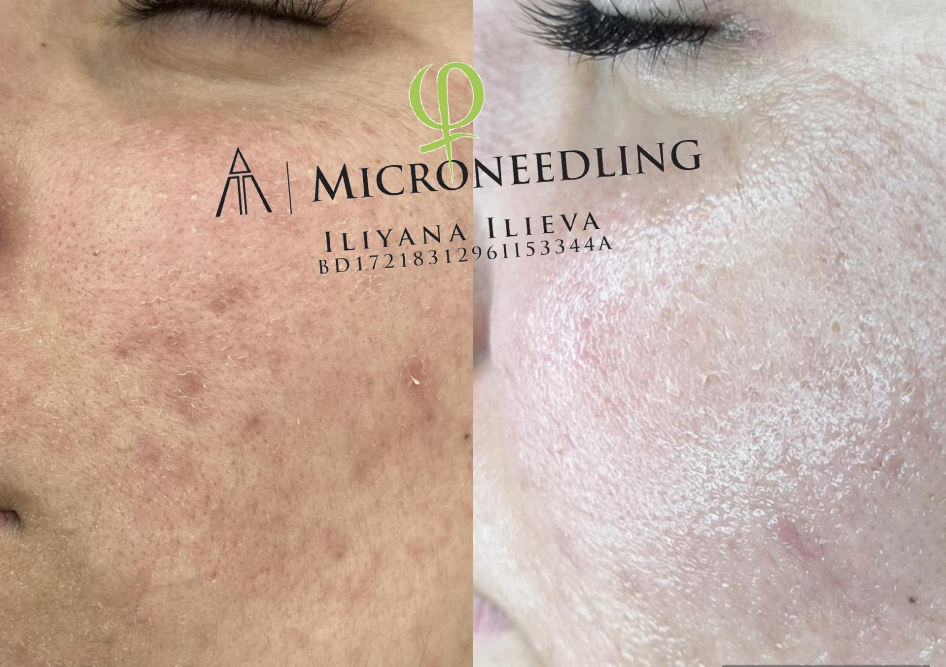 Микронидлинг – Beauty Atelier IN
