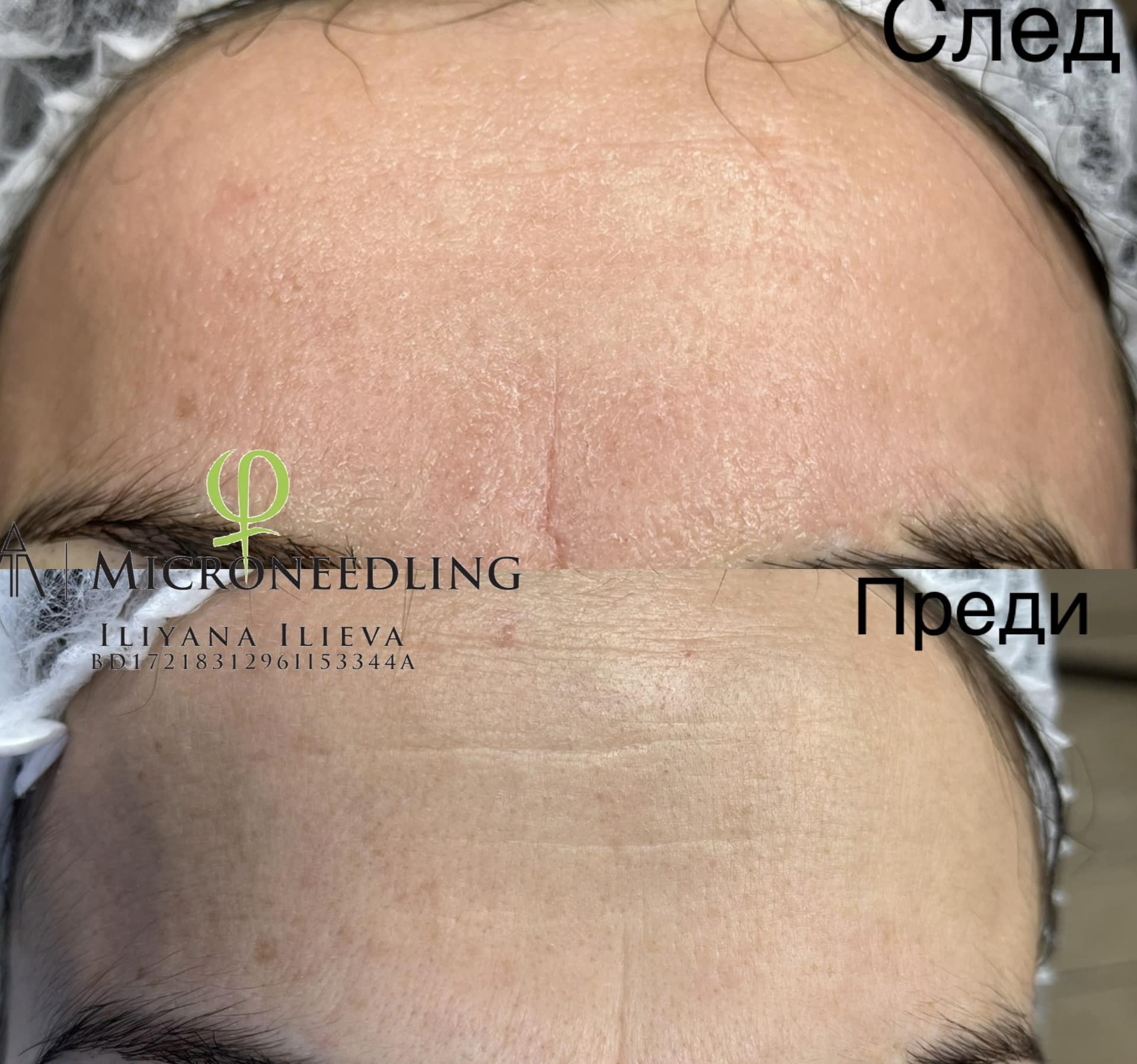 Микронидлинг – Beauty Atelier IN