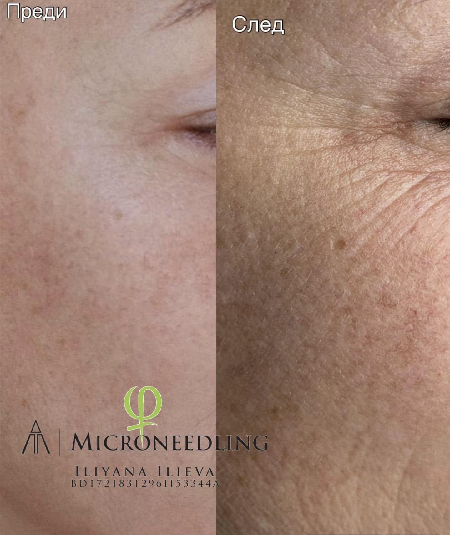 Микронидлинг – Beauty Atelier IN