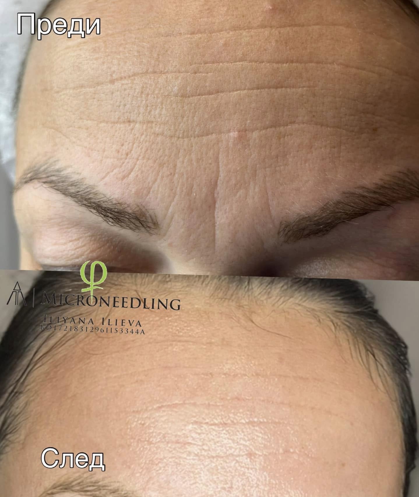 Микронидлинг – Beauty Atelier IN