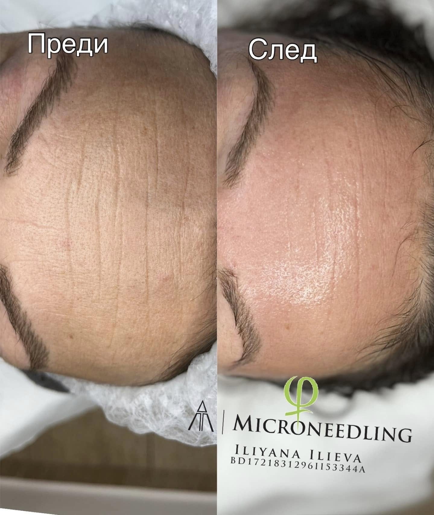 Микронидлинг – Beauty Atelier IN