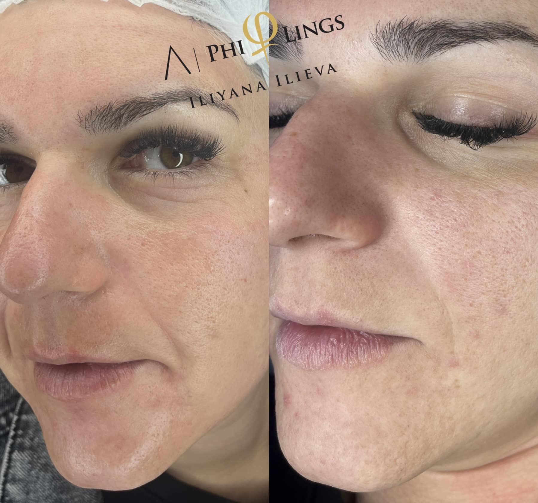 Микронидлинг – Beauty Atelier IN