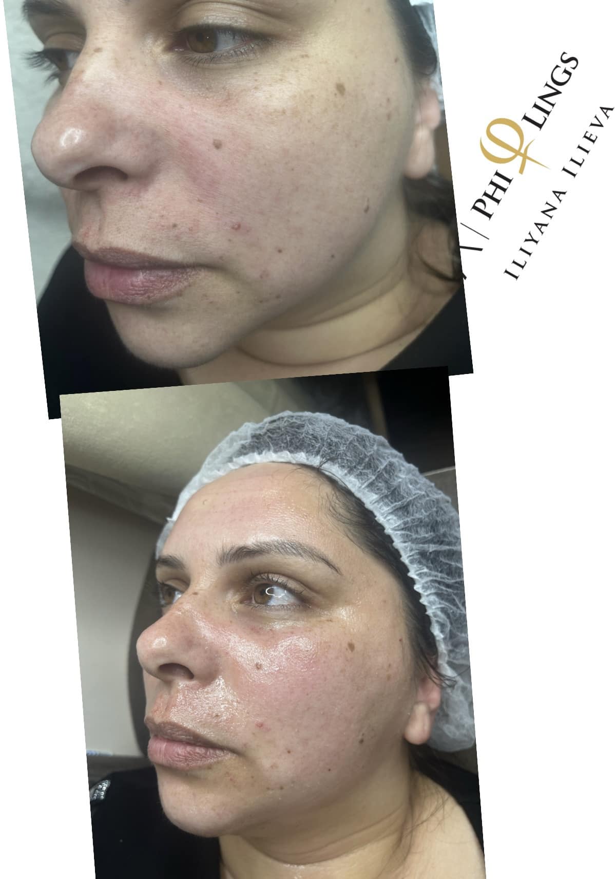 Микронидлинг – Beauty Atelier IN