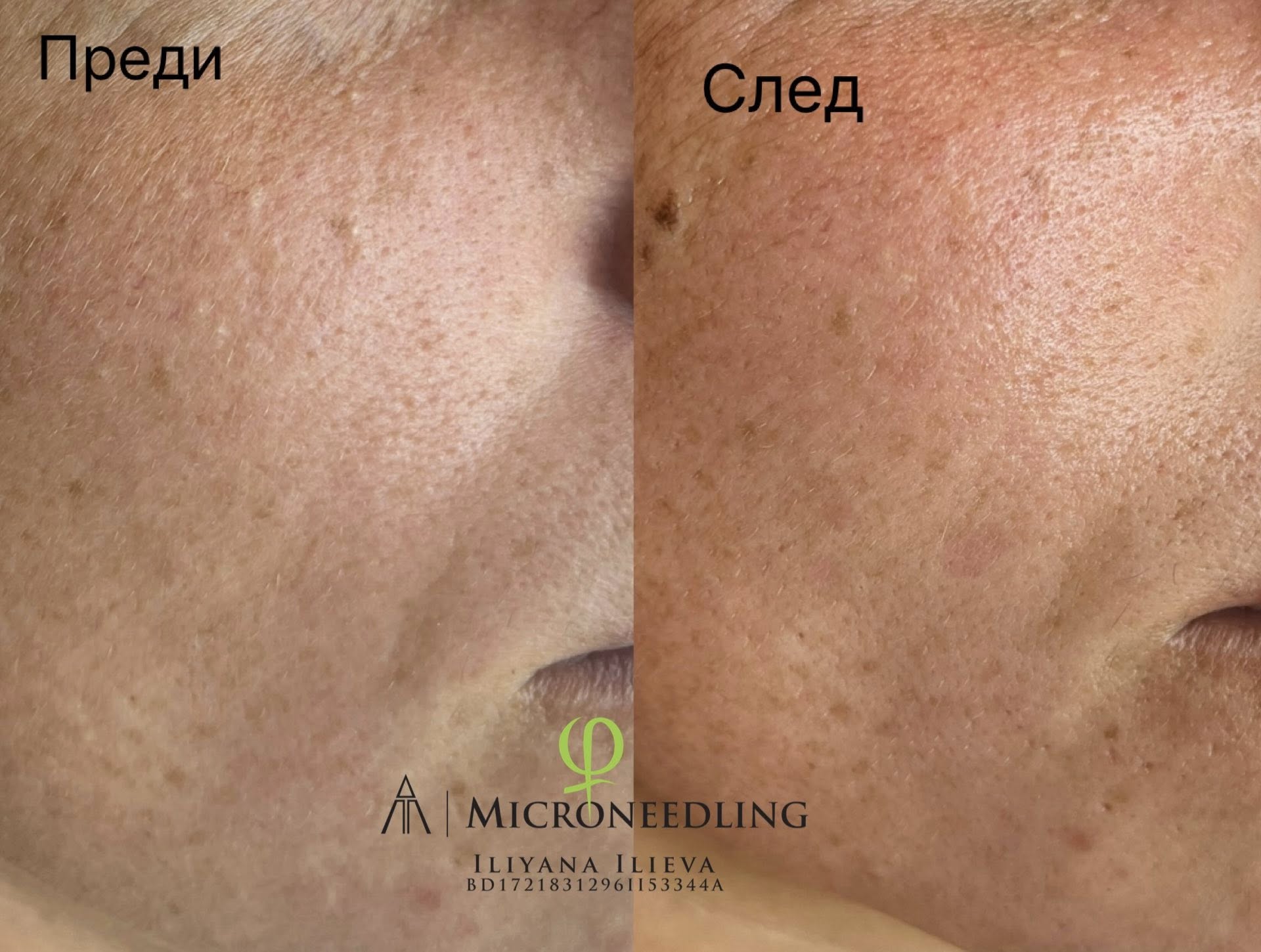 Микронидлинг – Beauty Atelier IN