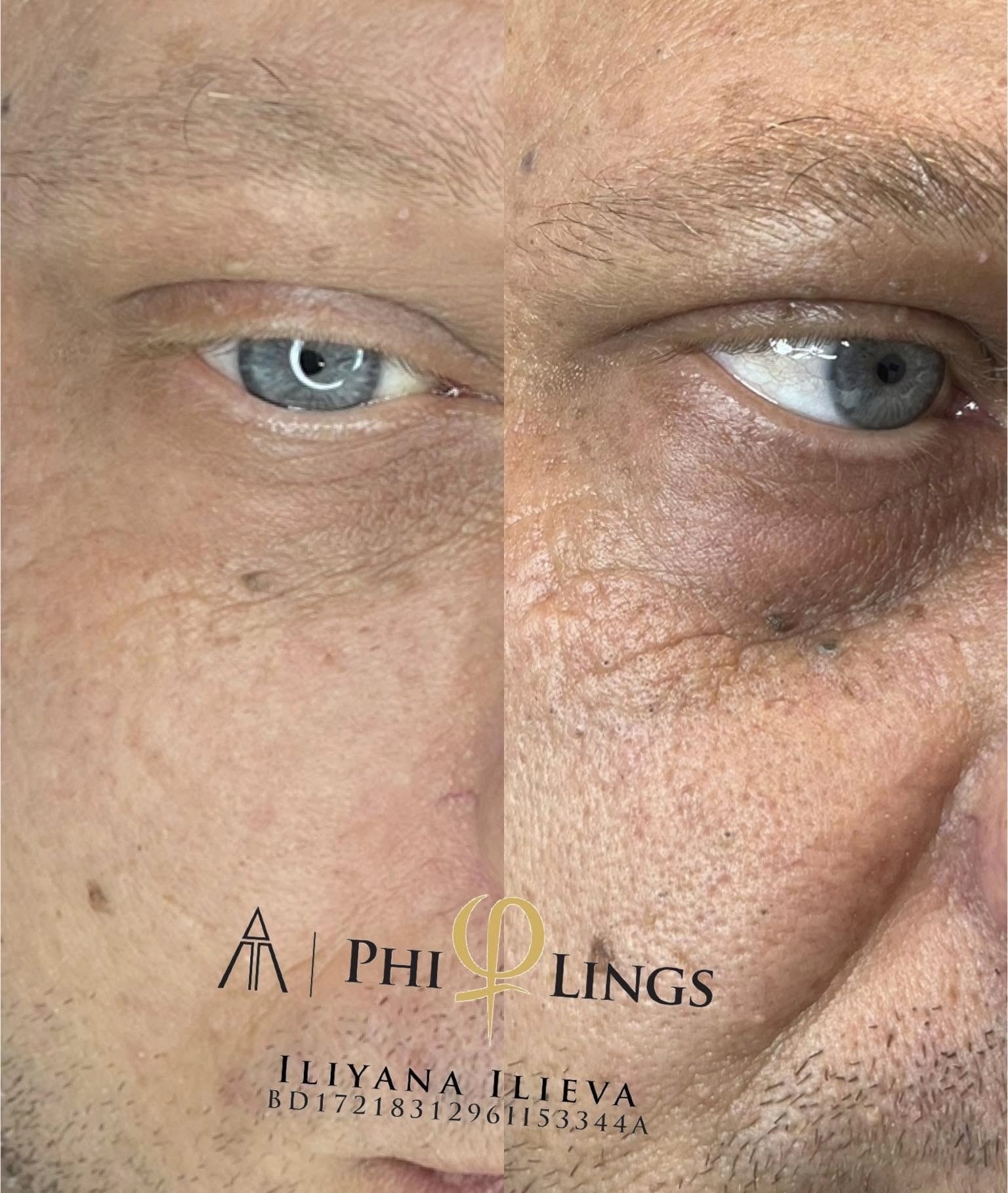 Микронидлинг – Beauty Atelier IN