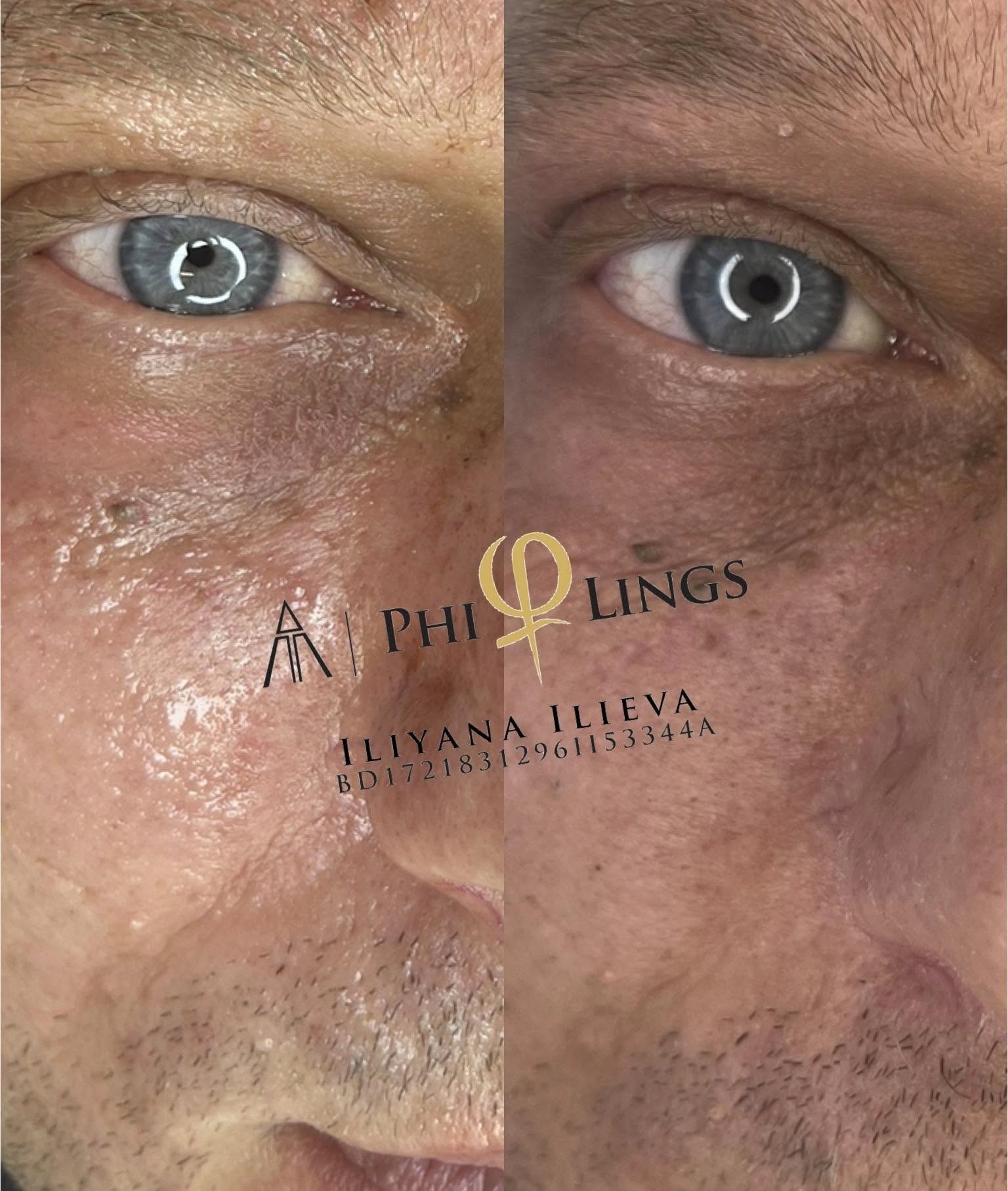 Микронидлинг – Beauty Atelier IN