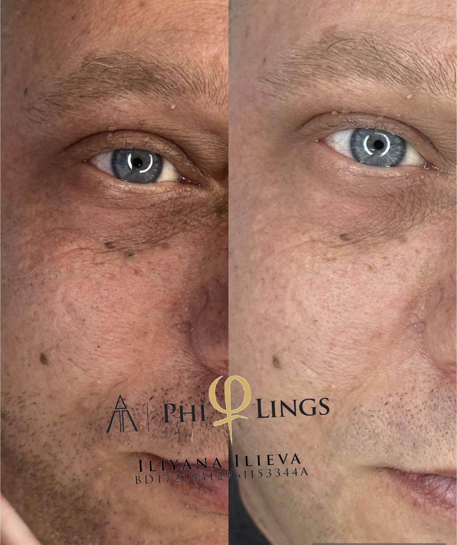 Микронидлинг – Beauty Atelier IN