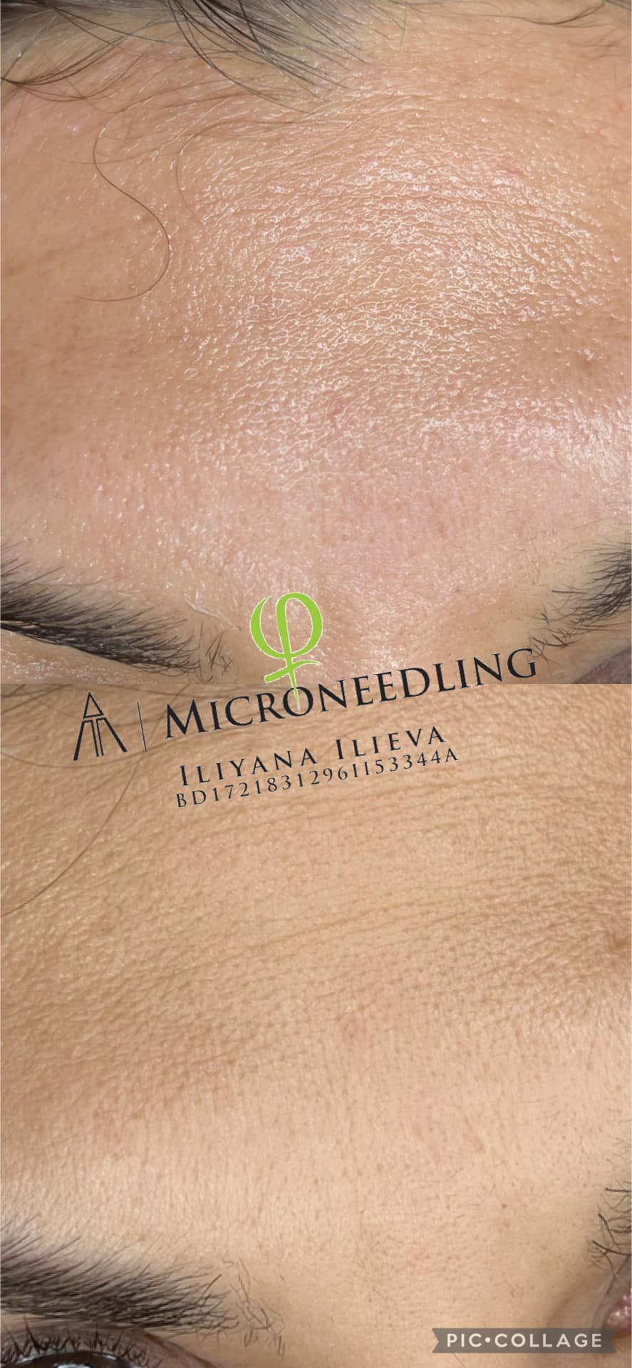 Микронидлинг – Beauty Atelier IN