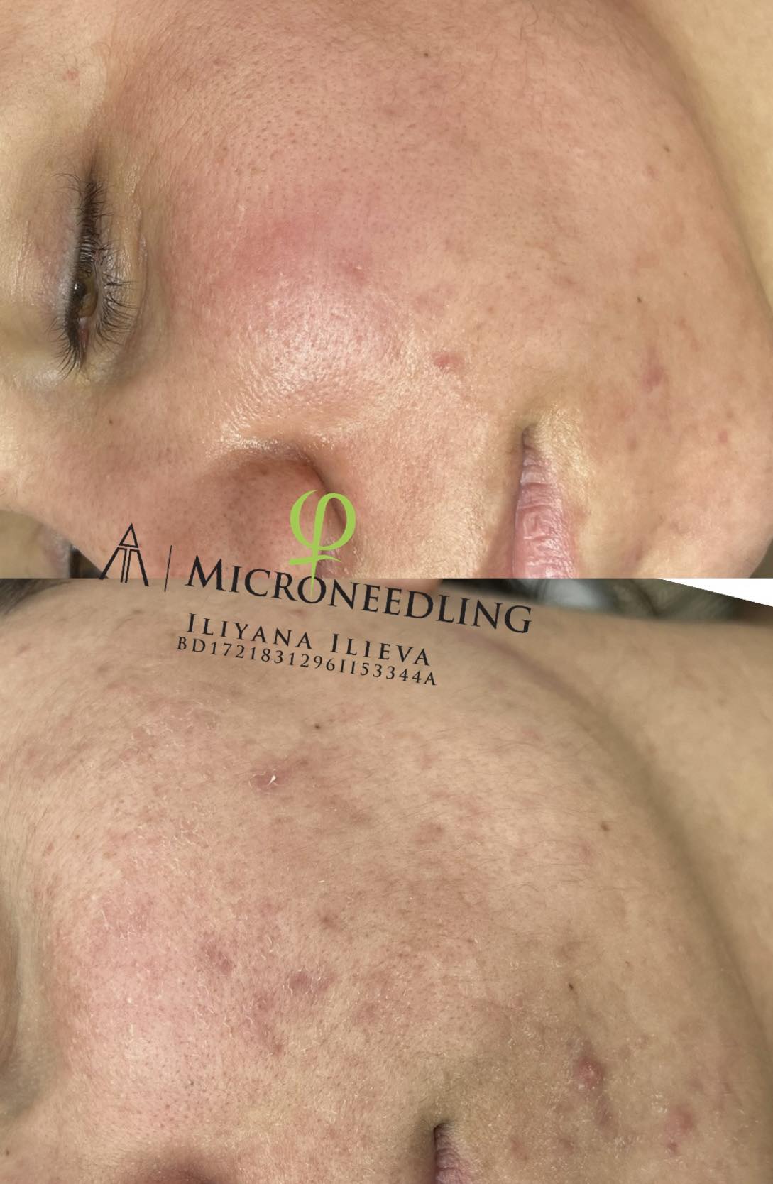 Микронидлинг – Beauty Atelier IN