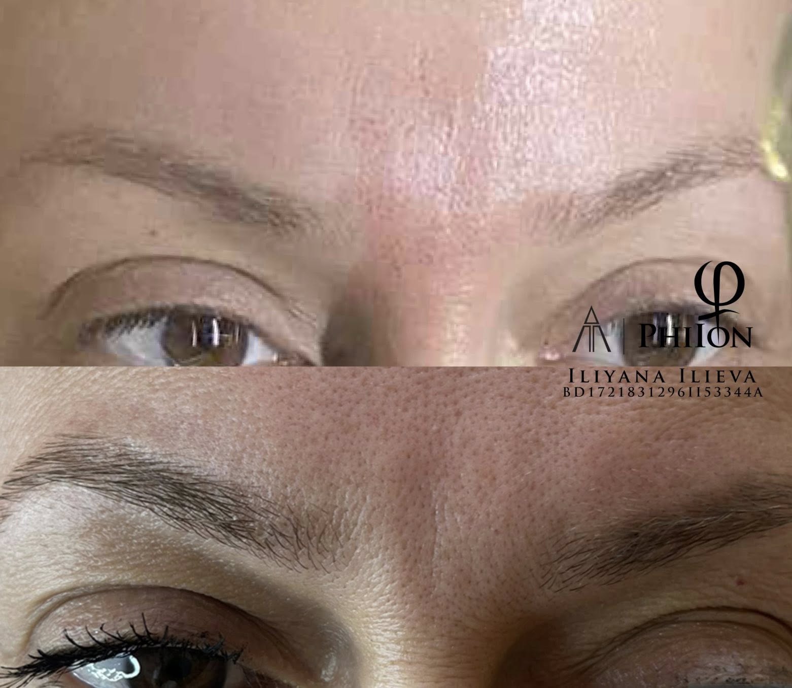 Плазма Пен – Beauty Atelier IN