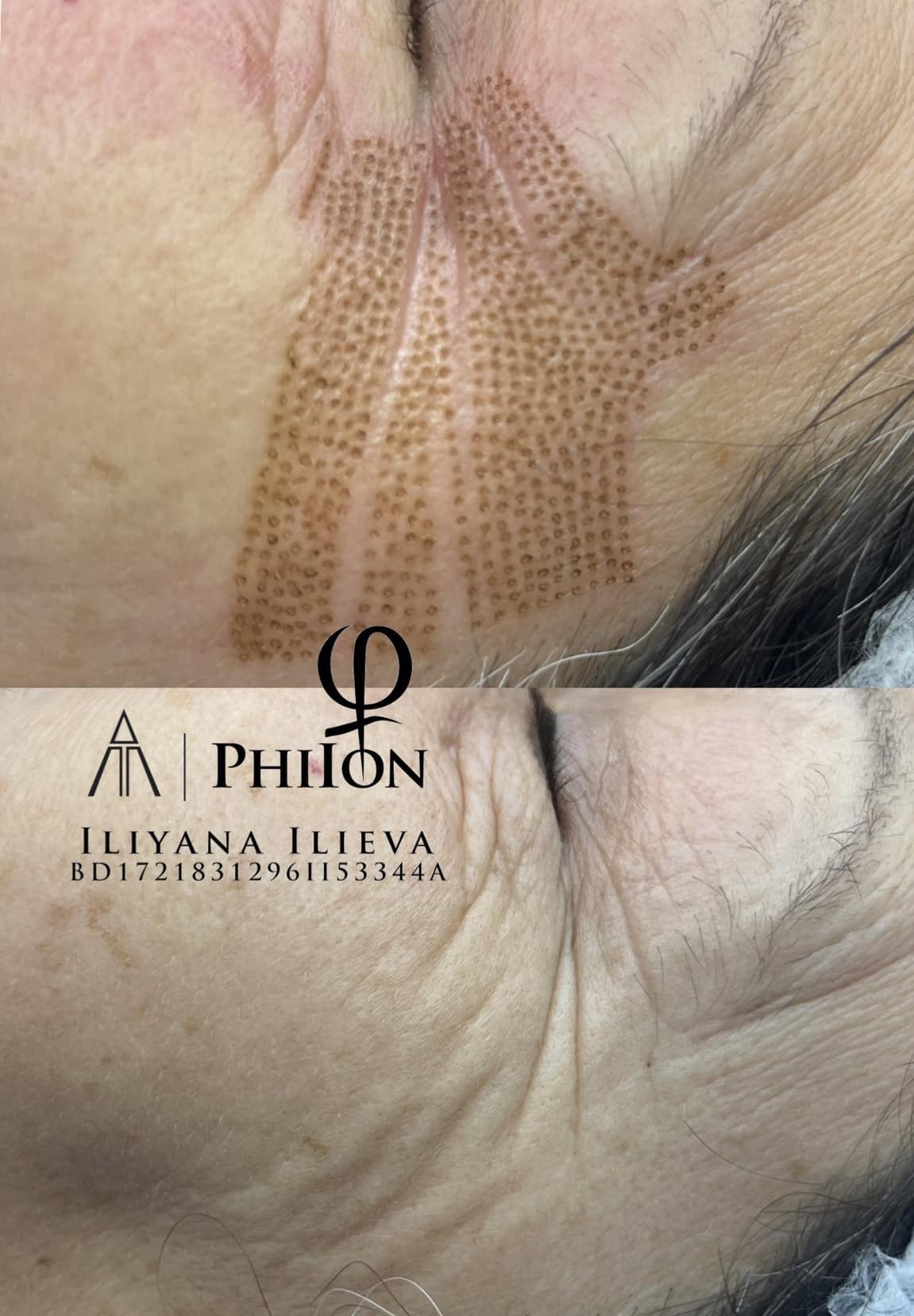 Плазма Пен – Beauty Atelier IN