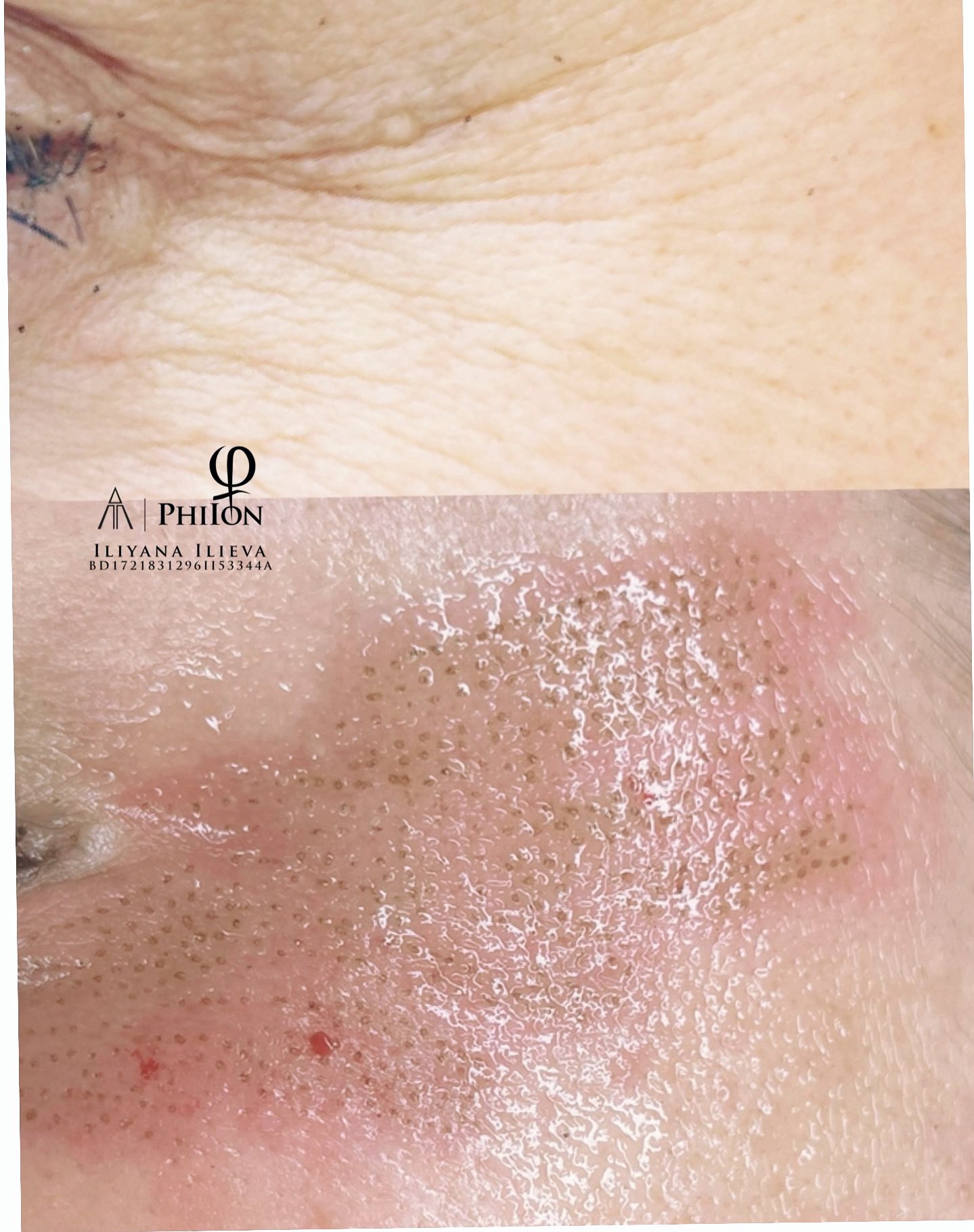 Плазма Пен – Beauty Atelier IN