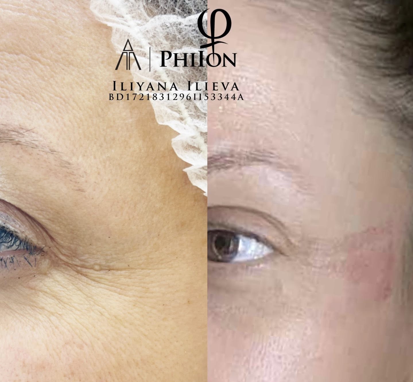 Плазма Пен – Beauty Atelier IN