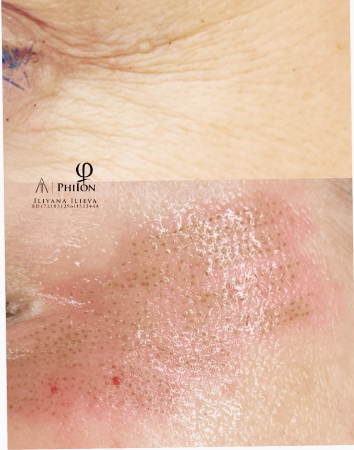 Плазма Пен – Beauty Atelier IN