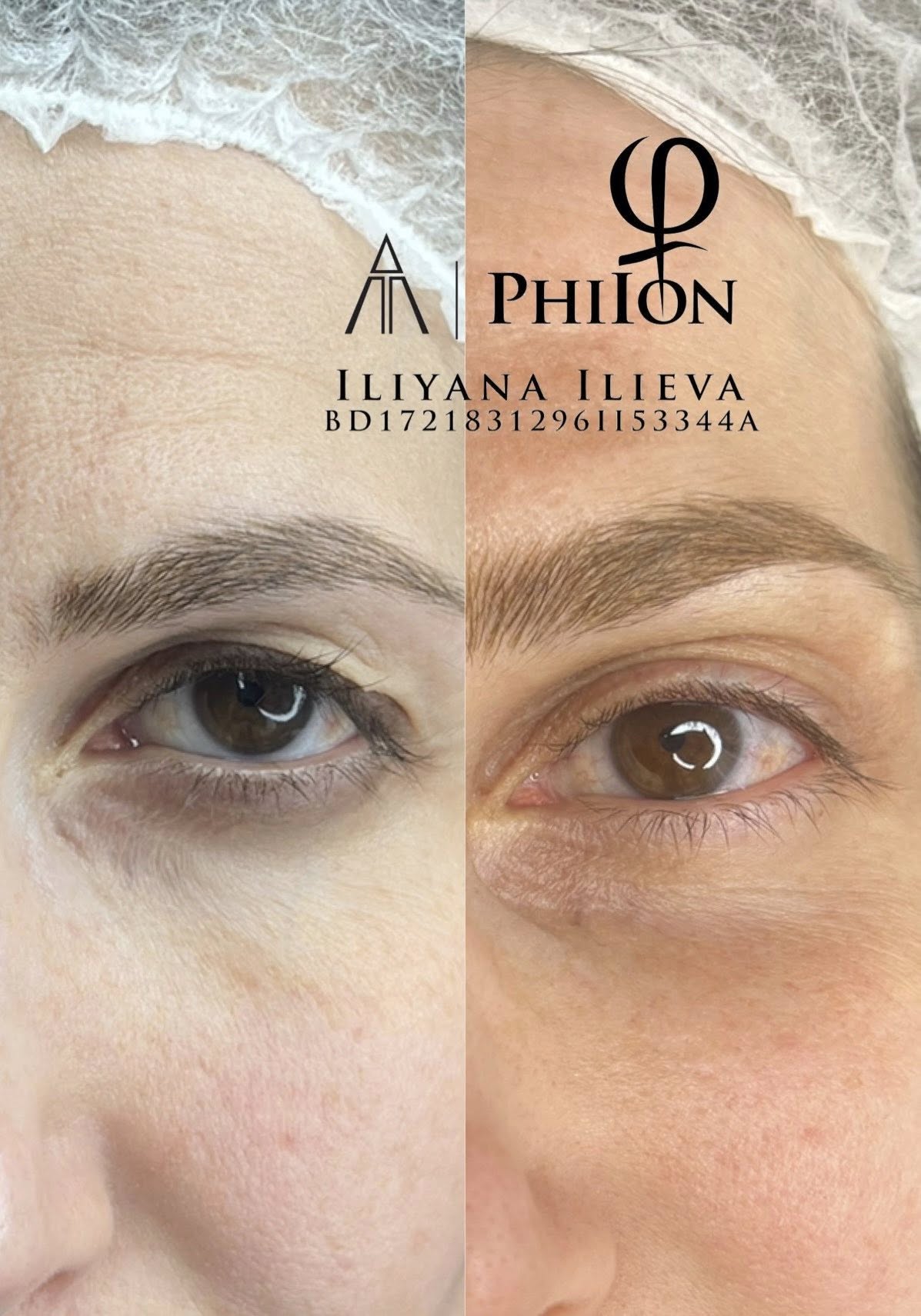 Плазма Пен – Beauty Atelier IN