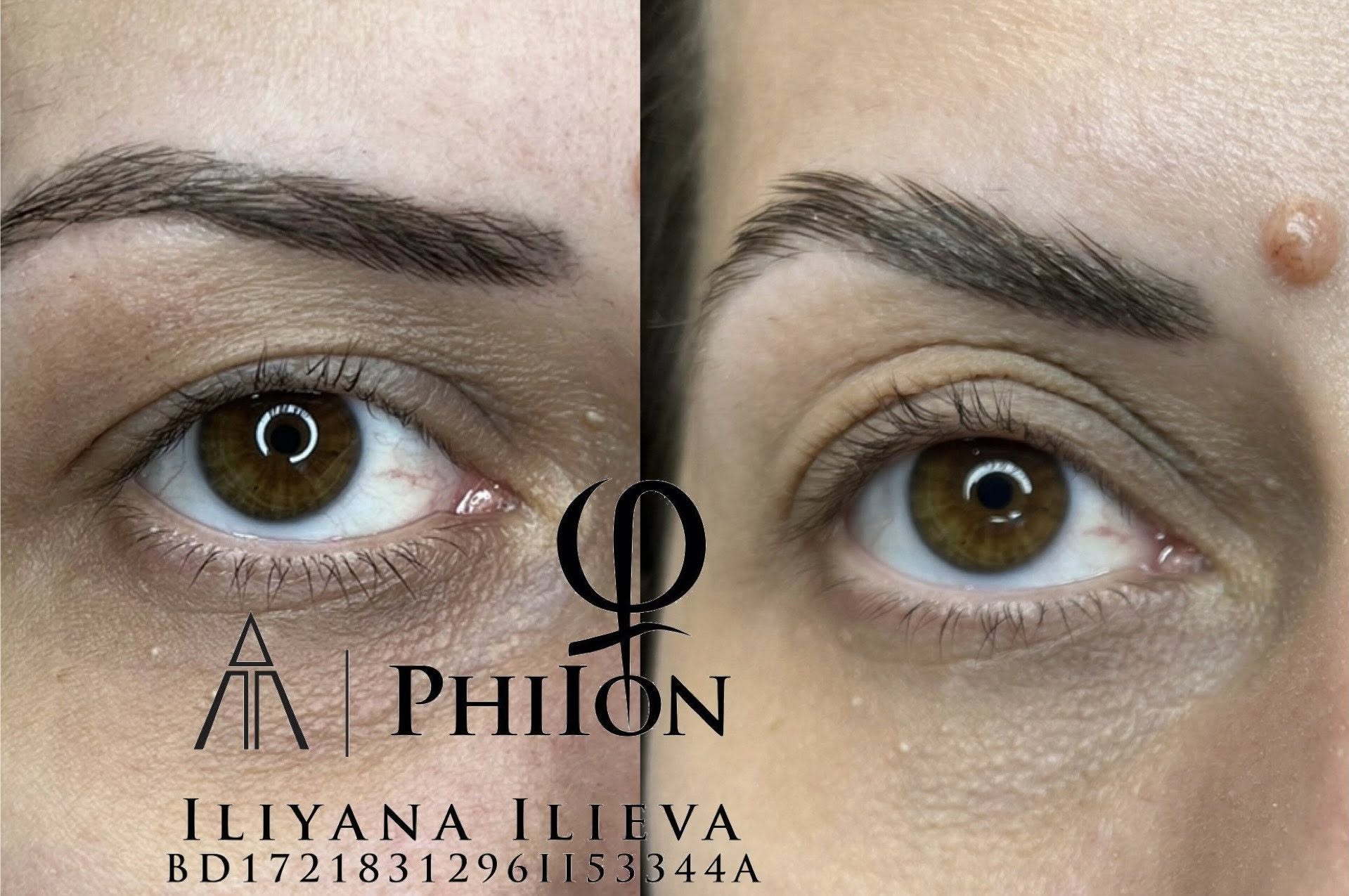 Плазма Пен – Beauty Atelier IN